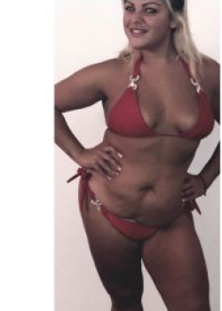 Abdominoplasty (Tummy Tuck) Before & After Image