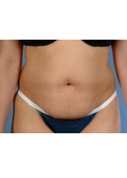 Abdominoplasty (Tummy Tuck) Before & After Image