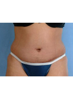 Tummy Tuck Before & After Image