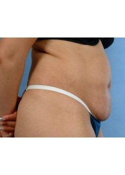Tummy Tuck Before & After Image