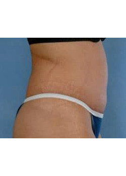 Tummy Tuck Before & After Image