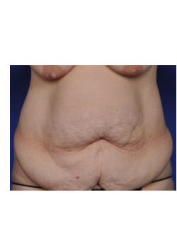 Abdominoplasty (Tummy Tuck) Before & After Image