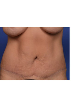 Tummy Tuck Before & After Image