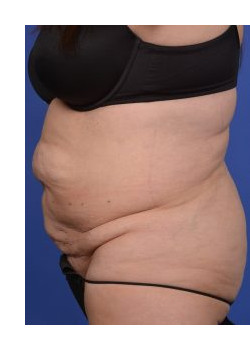 Tummy Tuck Before & After Image