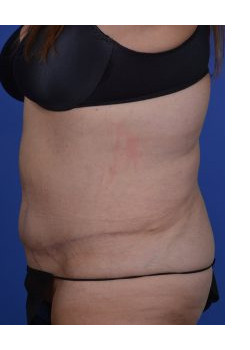 Tummy Tuck Before & After Image