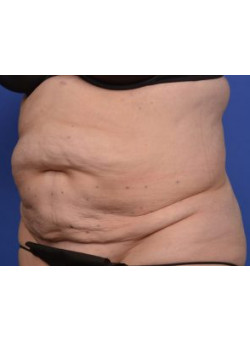 Tummy Tuck Before & After Image