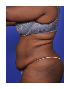 Tummy Tuck Before & After Image