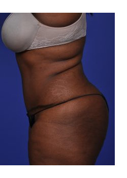 Abdominoplasty (Tummy Tuck) Before & After Image