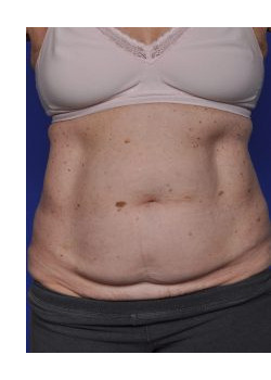 Tummy Tuck Before & After Image