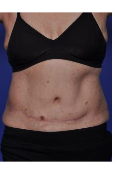 Tummy Tuck Before & After Image