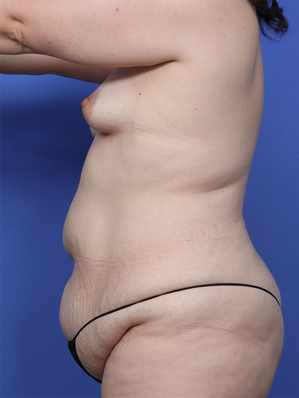 Abdominoplasty (Tummy Tuck) Before & After Image