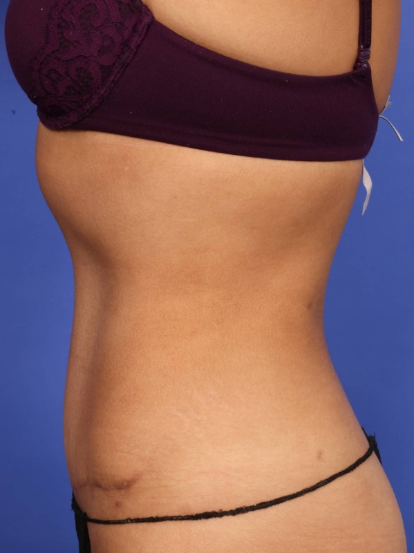 Tummy Tuck Before & After Image