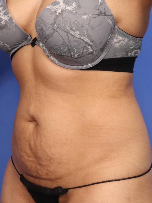 Tummy Tuck Before & After Image