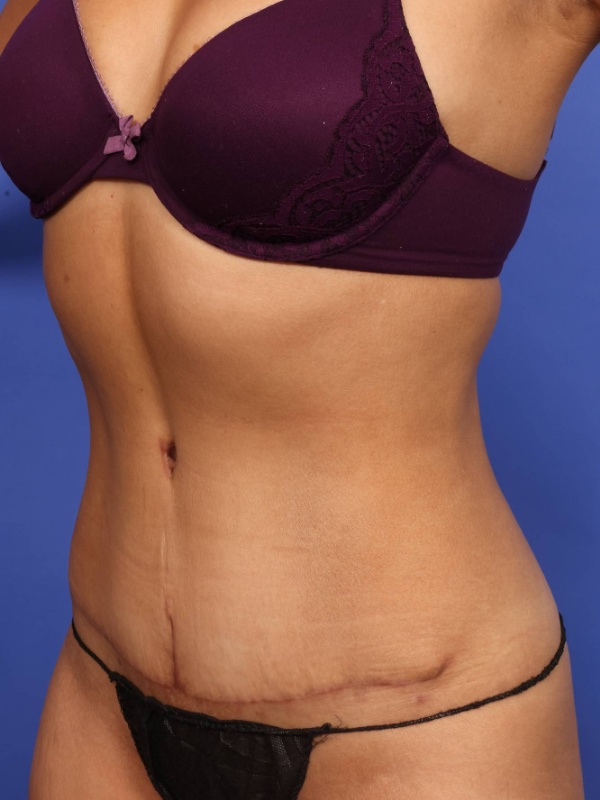 Tummy Tuck Before & After Image