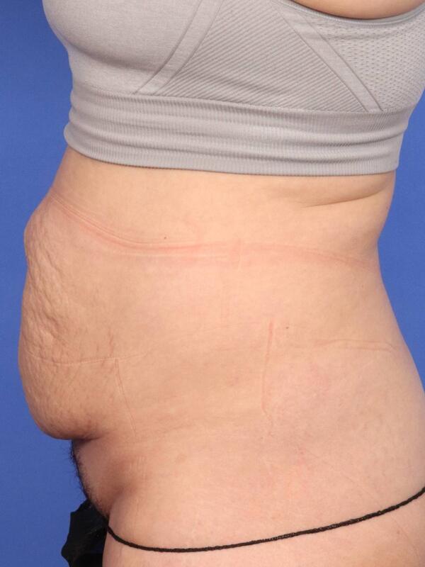 Tummy Tuck Before & After Image