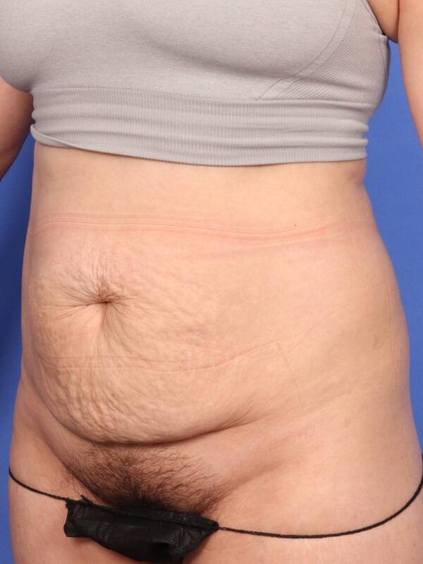 Tummy Tuck Before & After Image