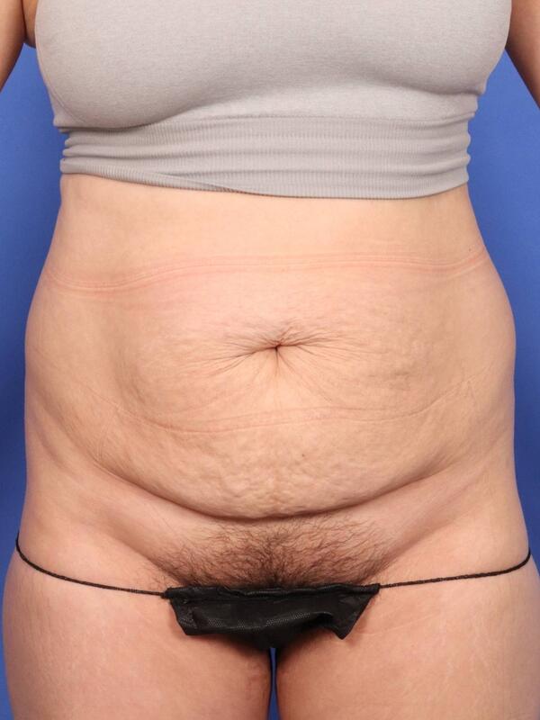 Tummy Tuck Before & After Image