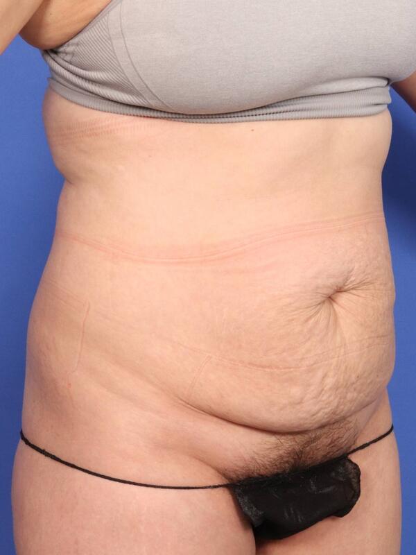 Tummy Tuck Before & After Image