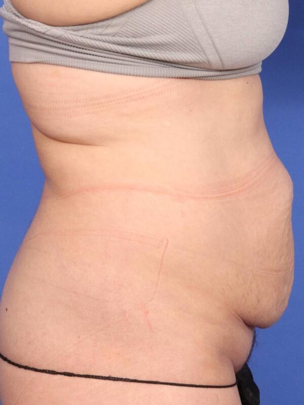 Tummy Tuck Before & After Image