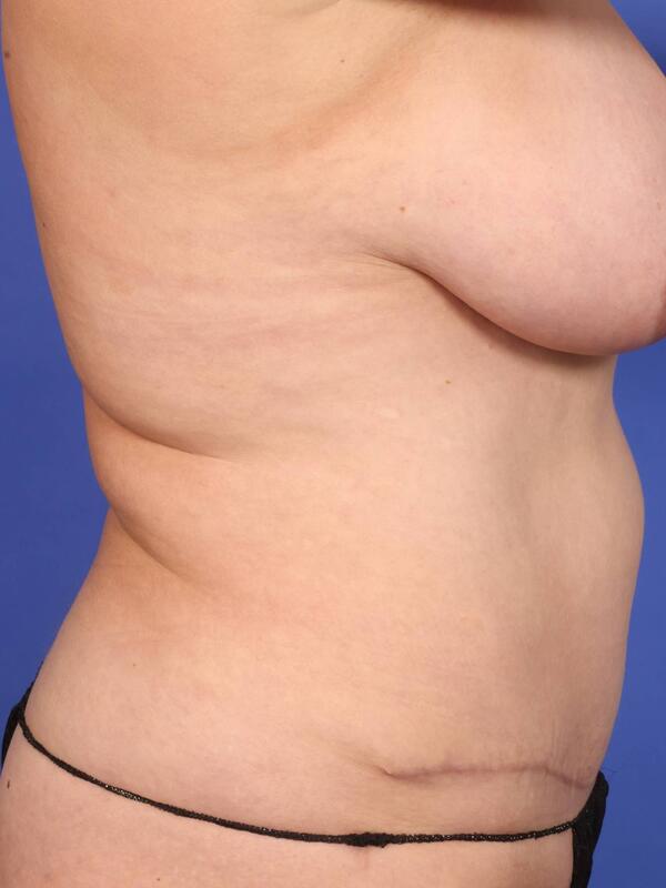 Tummy Tuck Before & After Image