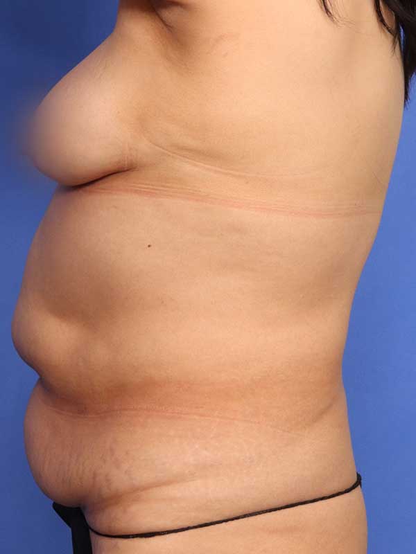 Abdominoplasty (Tummy Tuck) Before & After Image