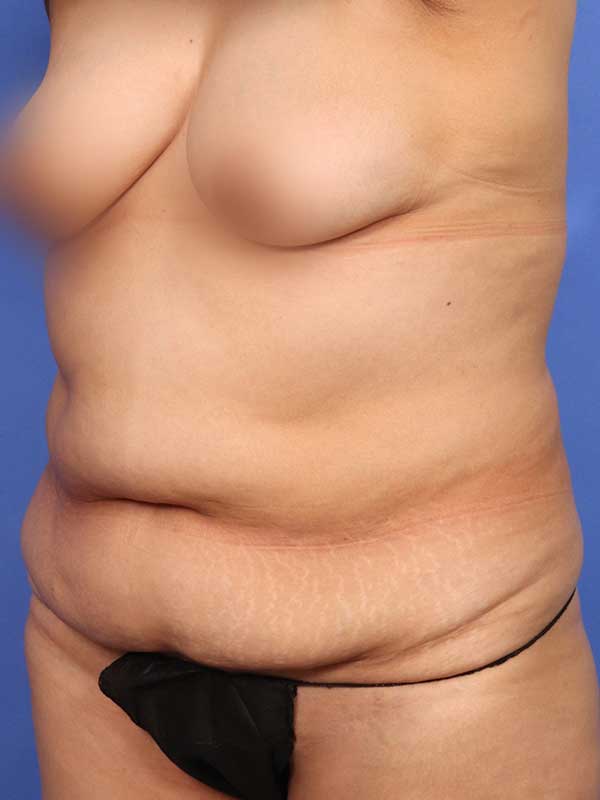 Tummy Tuck Before & After Image