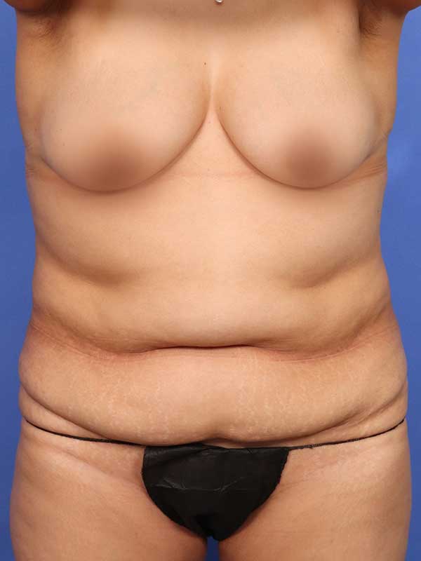 Tummy Tuck Before & After Image