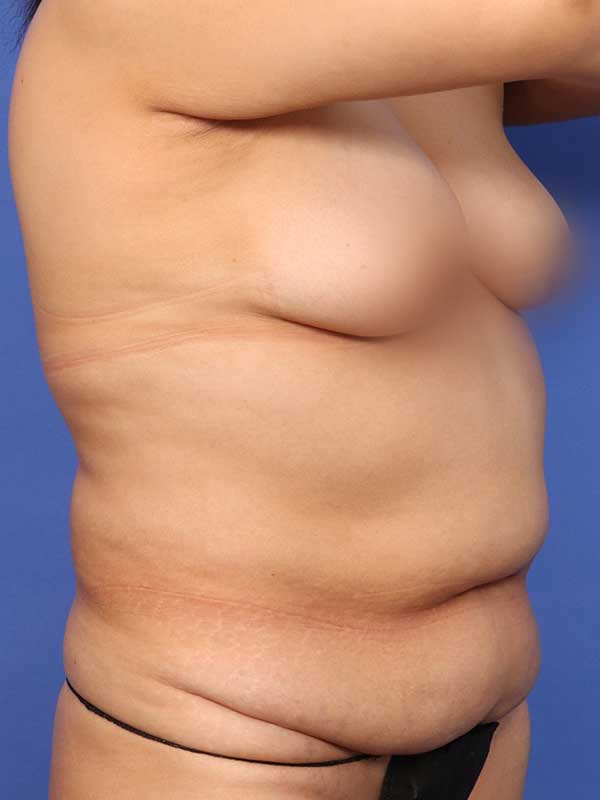 Tummy Tuck Before & After Image