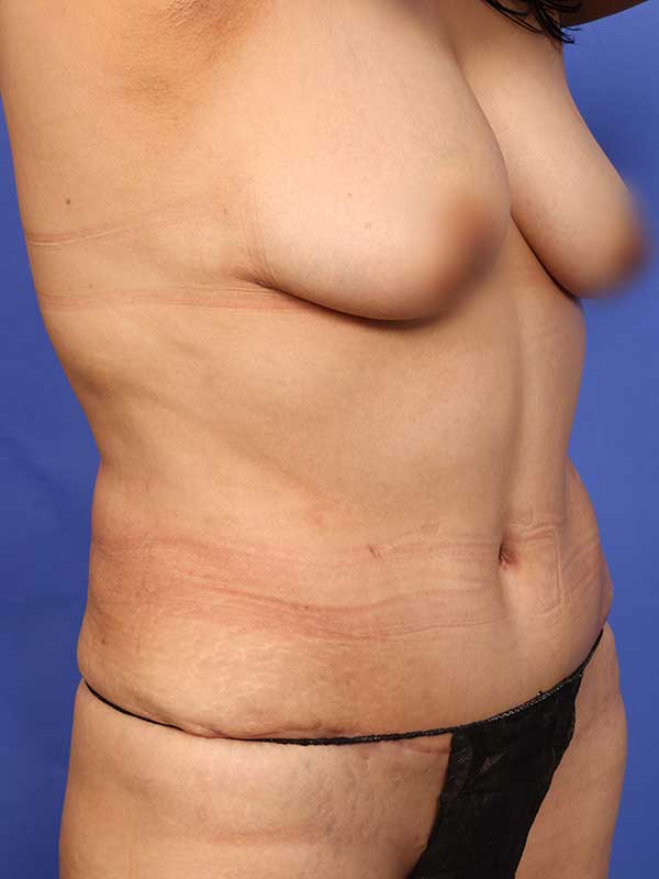 Tummy Tuck Before & After Image