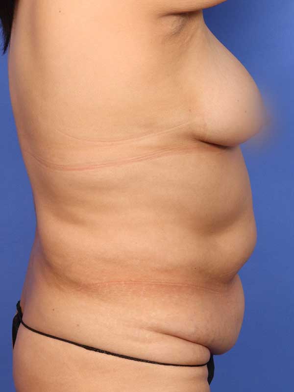 Tummy Tuck Before & After Image