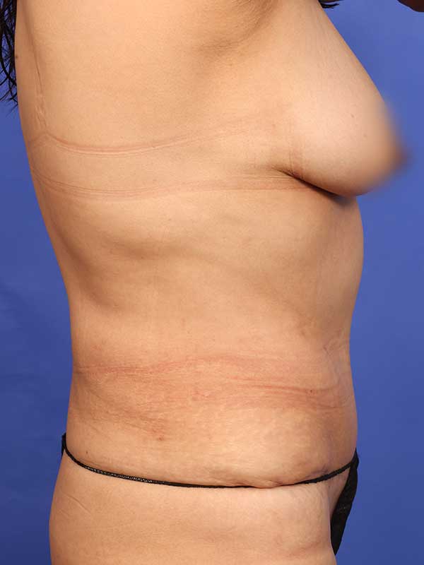 Tummy Tuck Before & After Image