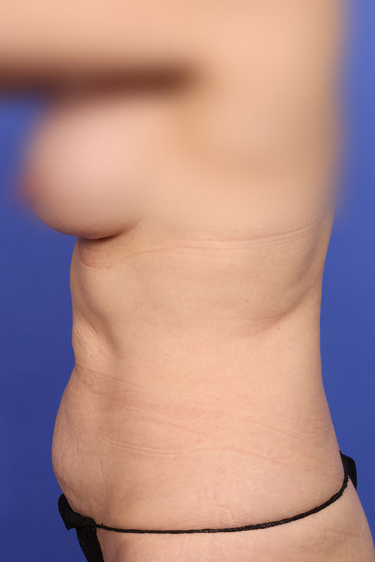 Tummy Tuck Before & After Image