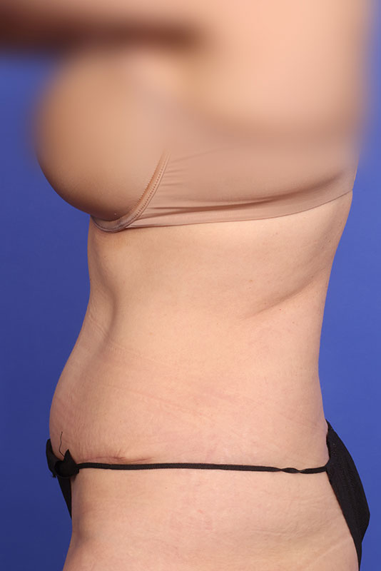 Tummy Tuck Before & After Image