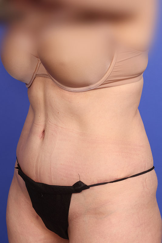 Tummy Tuck Before & After Image