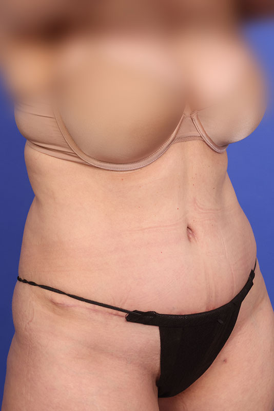 Tummy Tuck Before & After Image