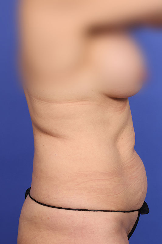 Tummy Tuck Before & After Image