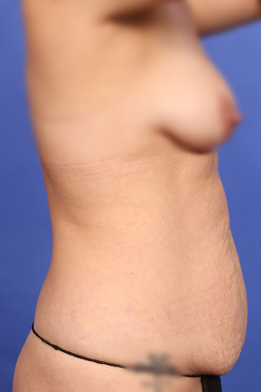 Abdominoplasty (Tummy Tuck) Before & After Image