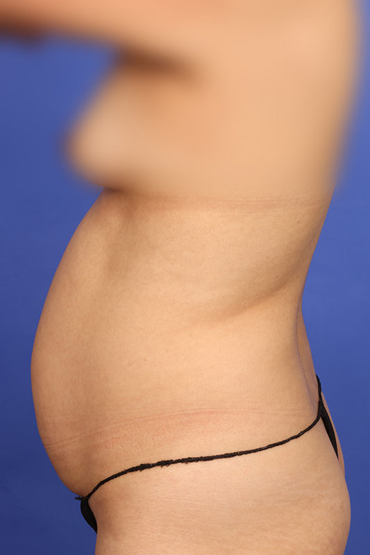 Tummy Tuck Before & After Image