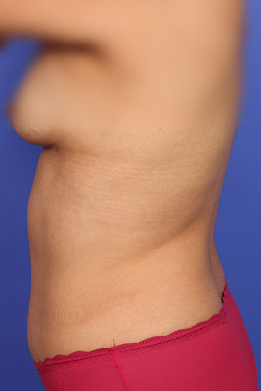 Tummy Tuck Before & After Image