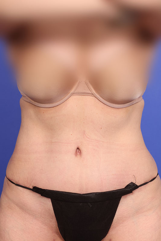 Abdominoplasty (Tummy Tuck) Before & After Image