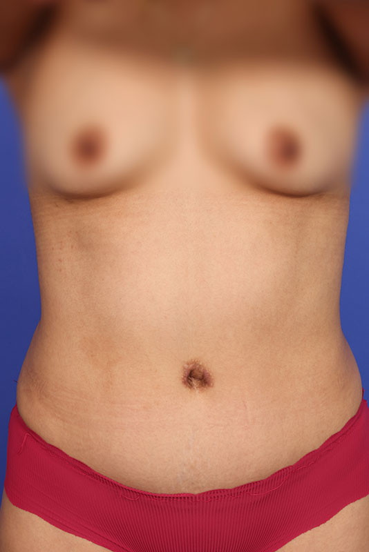 Tummy Tuck Before & After Image
