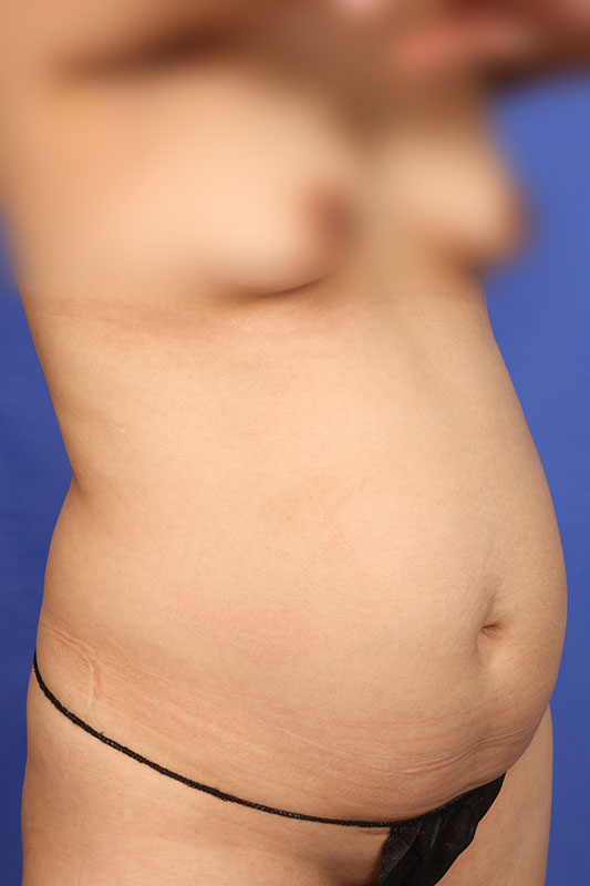 Tummy Tuck Before & After Image