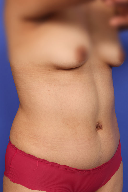 Tummy Tuck Before & After Image