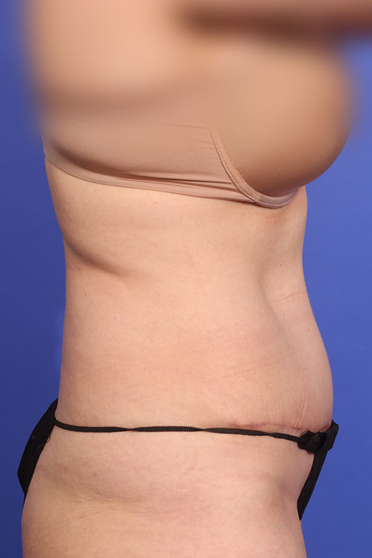 Abdominoplasty (Tummy Tuck) Before & After Image