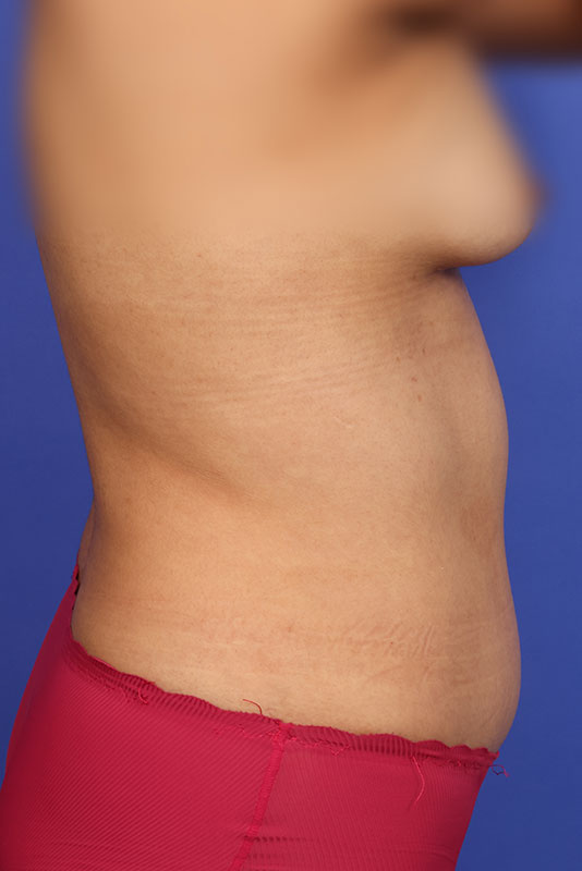 Tummy Tuck Before & After Image