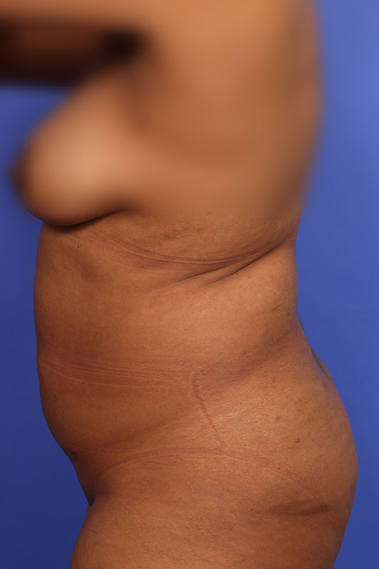 Tummy Tuck Before & After Image