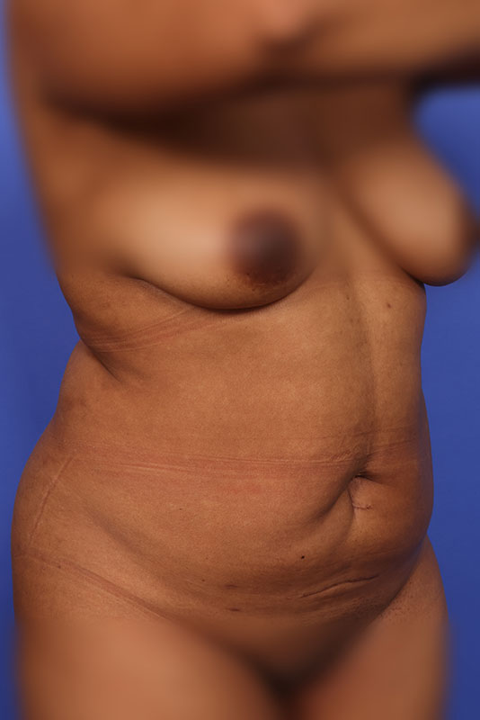 Tummy Tuck Before & After Image