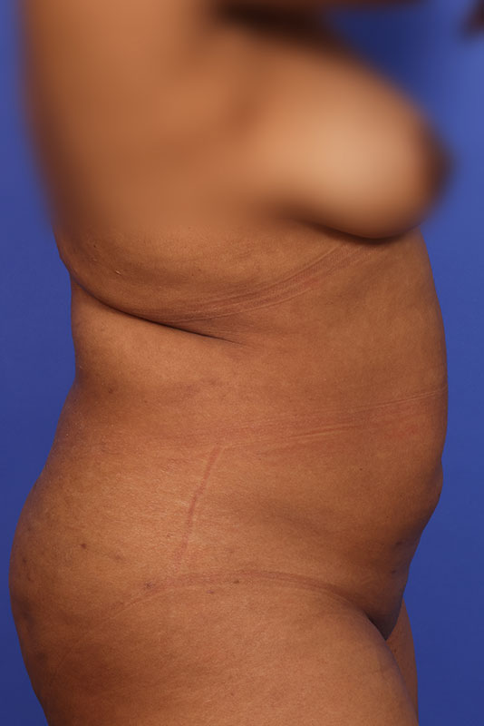 Tummy Tuck Before & After Image