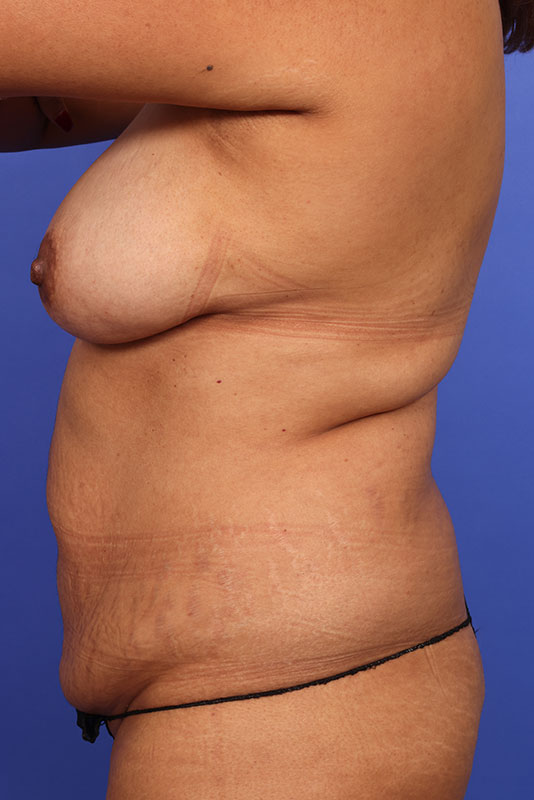 Tummy Tuck Before & After Image