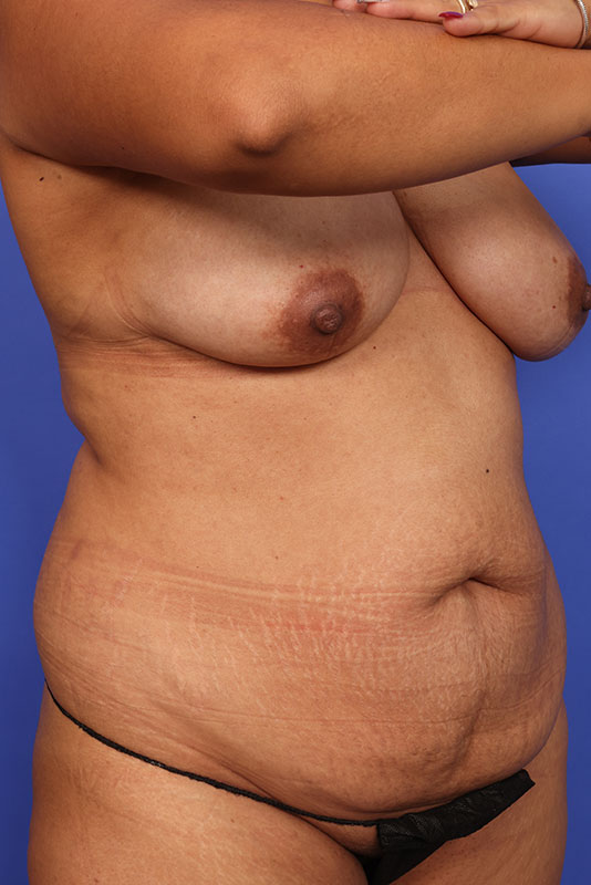 Tummy Tuck Before & After Image